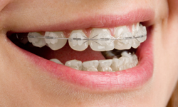 Clear Ceramic Braces 