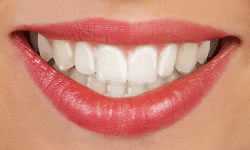 Clear Aligners