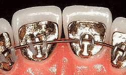 Lingual Braces